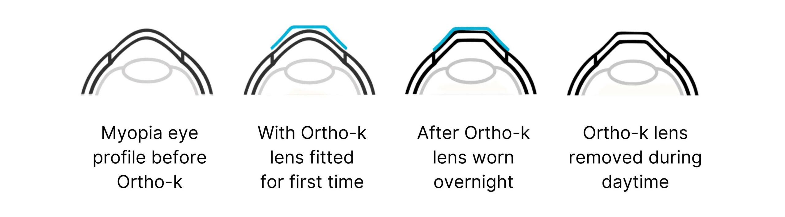 Ortho k lens scaled