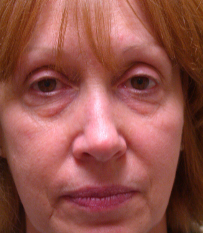 Blepharoplasty lower lid, removal of excess skin &fat