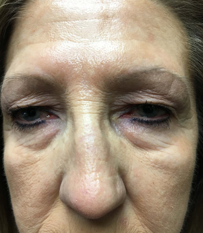 Blepharoplasty for the upper eyelid and repair for Ptosis.
