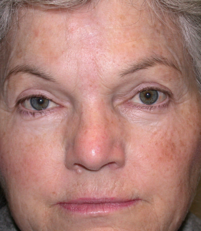 An endoscopic brow lift is a minimally invasive surgical procedure that aims to lift and tighten the brow area.