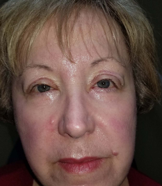 Ptosis repair, also known as eyelid ptosis surgery or ELR (eyelid retractor repair), is a medical procedure performed to correct droopy eyelids.