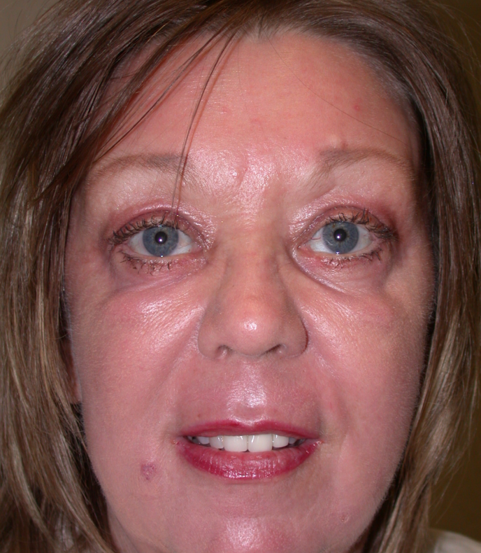 Quad Blepharoplasty, removal of excess skin 8 fat, eyelid lift, ful face resurfacing