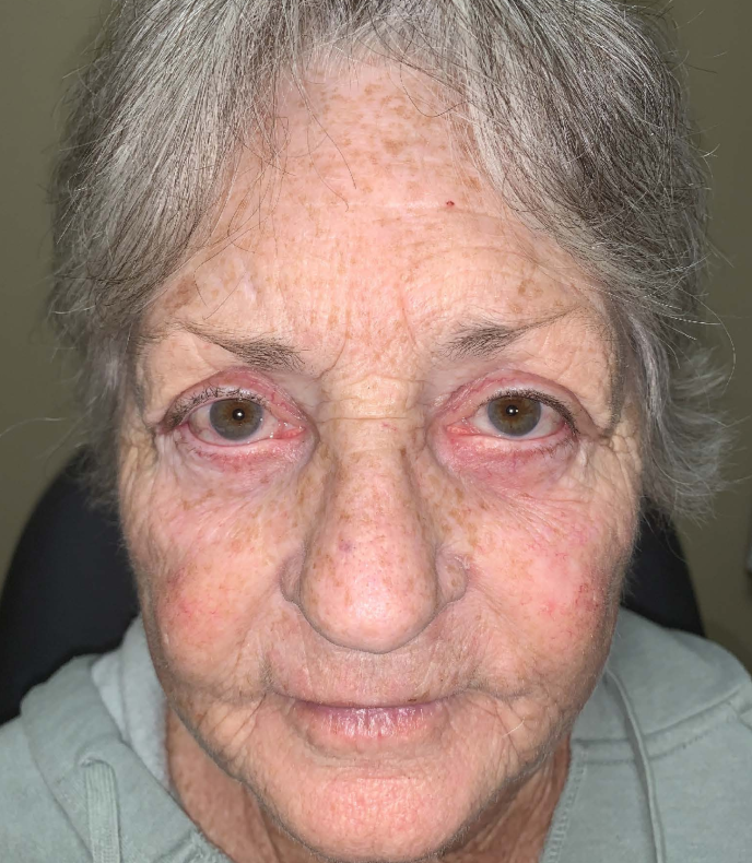 Quad Blepharoplasty is a surgical procedure that involves the removal of excess skin and fat from the upper and lower eyelids.