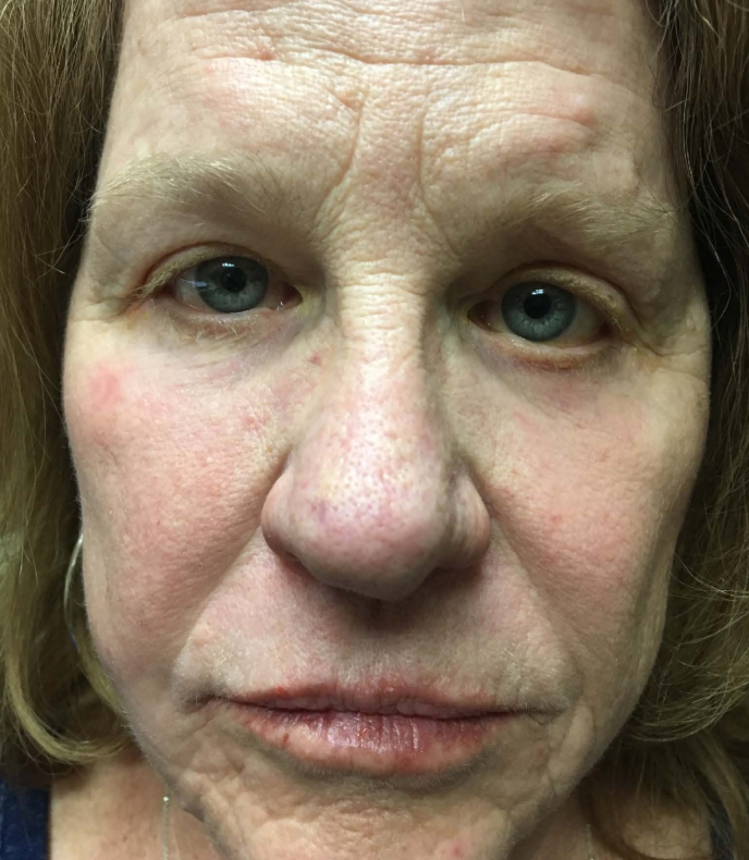 Ptosis repair, also known as eyelid ptosis surgery or eyelid lift surgery, is a procedure performed to correct droopy eyelids. The surgery involves lifting the eyelid to improve vision and enhance the appearance of the eyes.