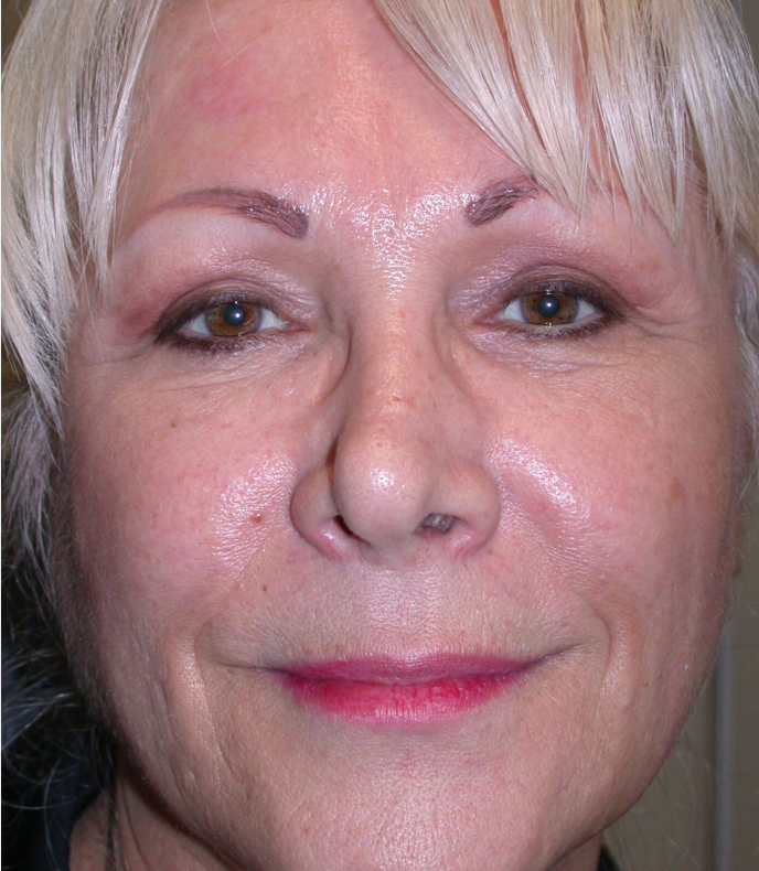 Quad Blepharoplasty is a surgical procedure that involves the removal of excess skin and fat from the upper and lower eyelids.