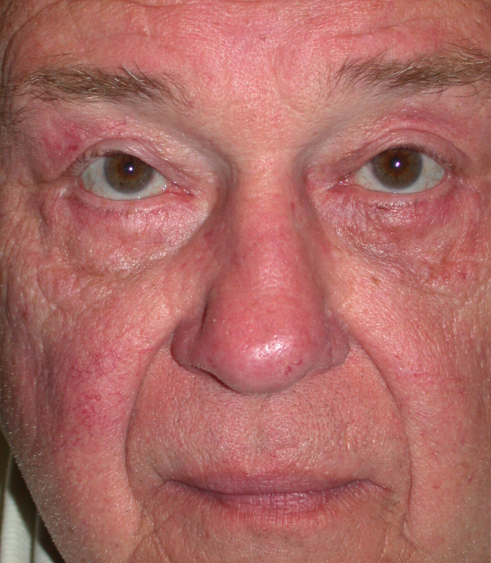 Quad Blepharoplasty, removal of excess skin § fat