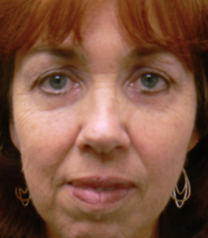 Quad Blepharoplasty, removal of excess skin § fat
