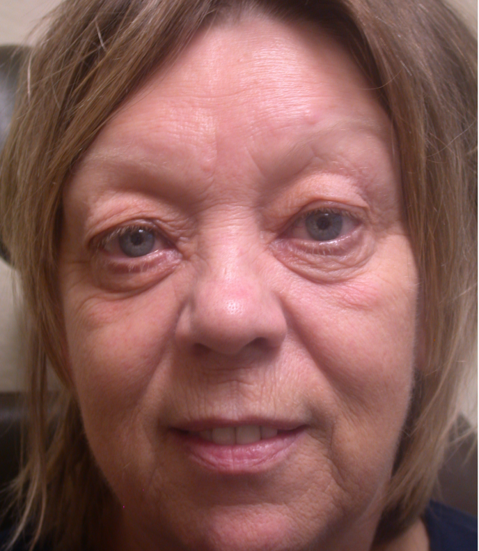 Quad Blepharoplasty, removal of excess skin 8 fat, eyelid lift, ful face resurfacing